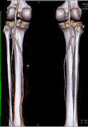 Minimal Disease Left Trifurcation Artery - CTisus CT Scan