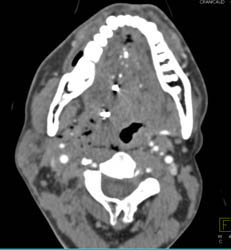 GSW Neck Without Carotid Injury- Artifact Clearly Seen - CTisus CT Scan