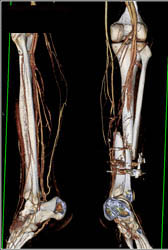 Complex Fractures With Vascular Injuries - CTisus CT Scan