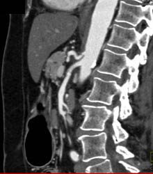 Median Arcuate Ligament Syndrome - CTisus CT Scan