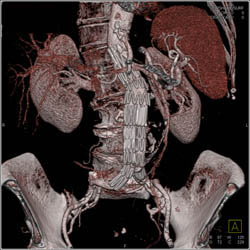 Material Failure of Stent - CTisus CT Scan