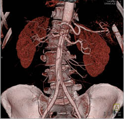 Prehilar Branching Right Renal Artery - CTisus CT Scan