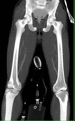 Runoff Study Without Stenosis - CTisus CT Scan