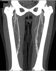 Diseased Aorta With Extensive Plaque - CTisus CT Scan