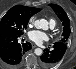 Pseudo-aneurysm Ascending Aorta Compresses SVC - CTisus CT Scan