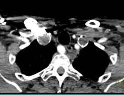 Occluded Subclavian Arteries - CTisus CT Scan