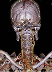 Normal Carotids and Circle of Willis (COW) But Left Vertebral Artery Aneurysms - CTisus CT Scan