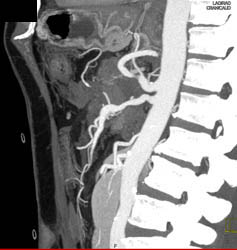 Mild SMA Plaque - CTisus CT Scan