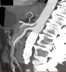 Mild Celiac Stenosis - CTisus CT Scan