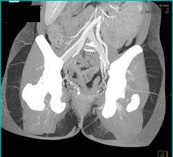 Planning for Superior Gluteal Perforator Surgery Planning - CTisus CT Scan