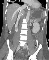 IVC Repair With Graft Following Resection Due to Renal Cell Carcinoma - CTisus CT Scan