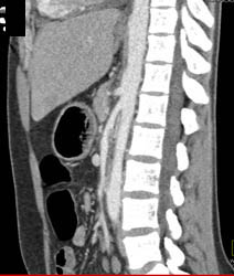 Superior Mesenteric Artery (SMA) Syndrome - CTisus CT Scan