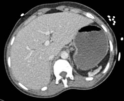 Superior Mesenteric Artery (SMA) Syndrome - CTisus CT Scan