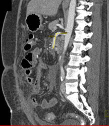 SMA Occlusion and Ischemic Bowel - CTisus CT Scan