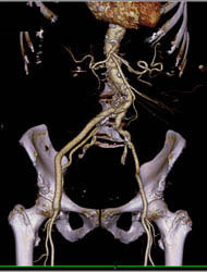 Abdominal Aortic Aneurysm (AAA) Repair With Graft Aorta to Right SFA - CTisus CT Scan