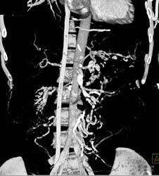 Vasculitis Involving Renal Arteries and Mesenteric Vessels - CTisus CT Scan