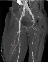 Bleed in Right Thigh S/P Stab Wound- See Soft Tissue 3D Images as Well - CTisus CT Scan