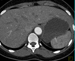 Takayasu's Arteritis With Narrowed Caliber of Aorta - CTisus CT Scan