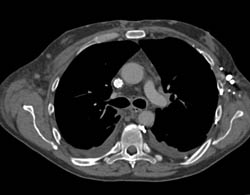 Stent in SVC With Collaterals as Well as IVC Stenosis and Huge Collaterals - CTisus CT Scan