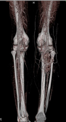 Vascular Tumor Calf Was A Synovial Cell Sarcoma - CTisus CT Scan