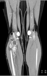 Vascular Tumor Calf Was A Synovial Cell Sarcoma - CTisus CT Scan