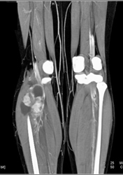 Vascular Tumor Calf Was A Synovial Cell Sarcoma - CTisus CT Scan