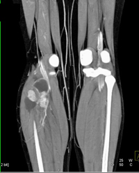 Vascular Tumor Calf Was A Synovial Cell Sarcoma - CTisus CT Scan