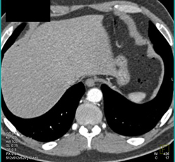 Celiac Artery Encased By Pancreatic Cancer - CTisus CT Scan