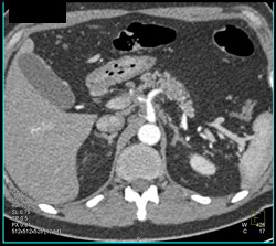 Celiac Artery Encased By Pancreatic Cancer - CTisus CT Scan