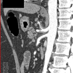 Celiac Artery Encased By Pancreatic Cancer - CTisus CT Scan