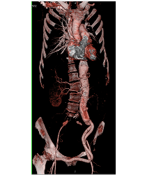 Endovascular Stent in Thoracic Aorta as Well as Right Common Iliac Artery With Fem-fem Bypass Graft. See Full Sequence of Images - CTisus CT Scan