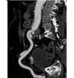 Endovascular Stent in Thoracic Aorta as Well as Right Common Iliac Artery With Fem-fem Bypass Graft. See Full Sequence of Images - CTisus CT Scan