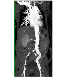 Endovascular Stent in Thoracic Aorta as Well as Right Common Iliac Artery With Fem-fem Bypass Graft. See Full Sequence of Images - CTisus CT Scan