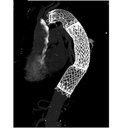 Endovascular Stent in Thoracic Aorta as Well as Right Common Iliac Artery With Fem-fem Bypass Graft. See Full Sequence of Images - CTisus CT Scan