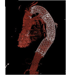 Endovascular Stent in Thoracic Aorta as Well as Right Common Iliac Artery With Fem-fem Bypass Graft. See Full Sequence of Images - CTisus CT Scan