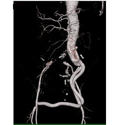 Endovascular Stent in Thoracic Aorta as Well as Right Common Iliac Artery With Fem-fem Bypass Graft. See Full Sequence of Images - CTisus CT Scan