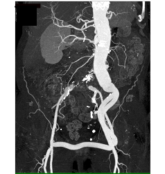 Endovascular Stent in Thoracic Aorta as Well as Right Common Iliac Artery With Fem-fem Bypass Graft. See Full Sequence of Images - CTisus CT Scan