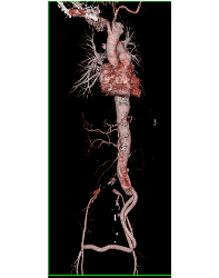 Endovascular Stent in Thoracic Aorta as Well as Right Common Iliac Artery With Fem-fem Bypass Graft. See Full Sequence of Images - CTisus CT Scan