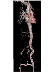 Endovascular Stent in Thoracic Aorta as Well as Right Common Iliac Artery With Fem-fem Bypass Graft. See Full Sequence of Images - CTisus CT Scan