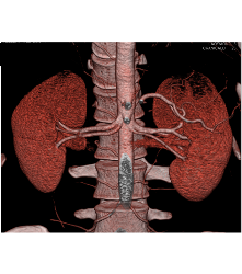 Normal 2 Renal Arteries to Each Kidney - CTisus CT Scan