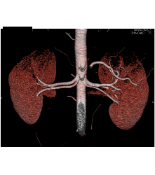 Normal 2 Renal Arteries to Each Kidney - CTisus CT Scan