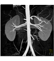 Normal 2 Renal Arteries to Each Kidney - CTisus CT Scan