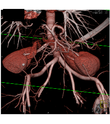 Normal 2 Renal Arteries to Each Kidney - CTisus CT Scan