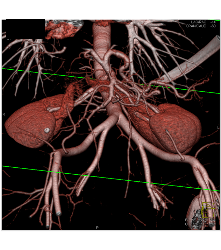 Normal 2 Renal Arteries to Each Kidney - CTisus CT Scan