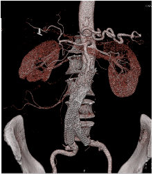 Endovascular Stent in Place - CTisus CT Scan