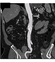 Endovascular Stent in Place - CTisus CT Scan