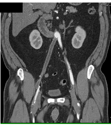 Occluded Stent to Bypass Right Iliac Artery With A Patent Fem-fem Bypass - CTisus CT Scan