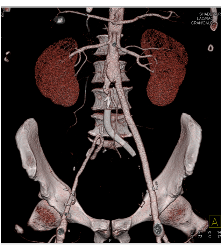 Occluded Stent to Bypass Right Iliac Artery With A Patent Fem-fem Bypass - CTisus CT Scan