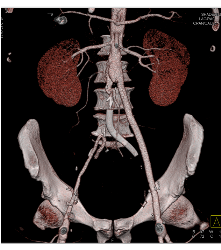 Occluded Stent to Bypass Right Iliac Artery With A Patent Fem-fem Bypass - CTisus CT Scan