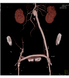 Occluded Stent to Bypass Right Iliac Artery With A Patent Fem-fem Bypass - CTisus CT Scan